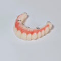 PMMA Bridge With Screw Retained