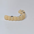 PMMA Bridge With Screw Retained