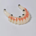 PMMA Bridge With Screw Retained