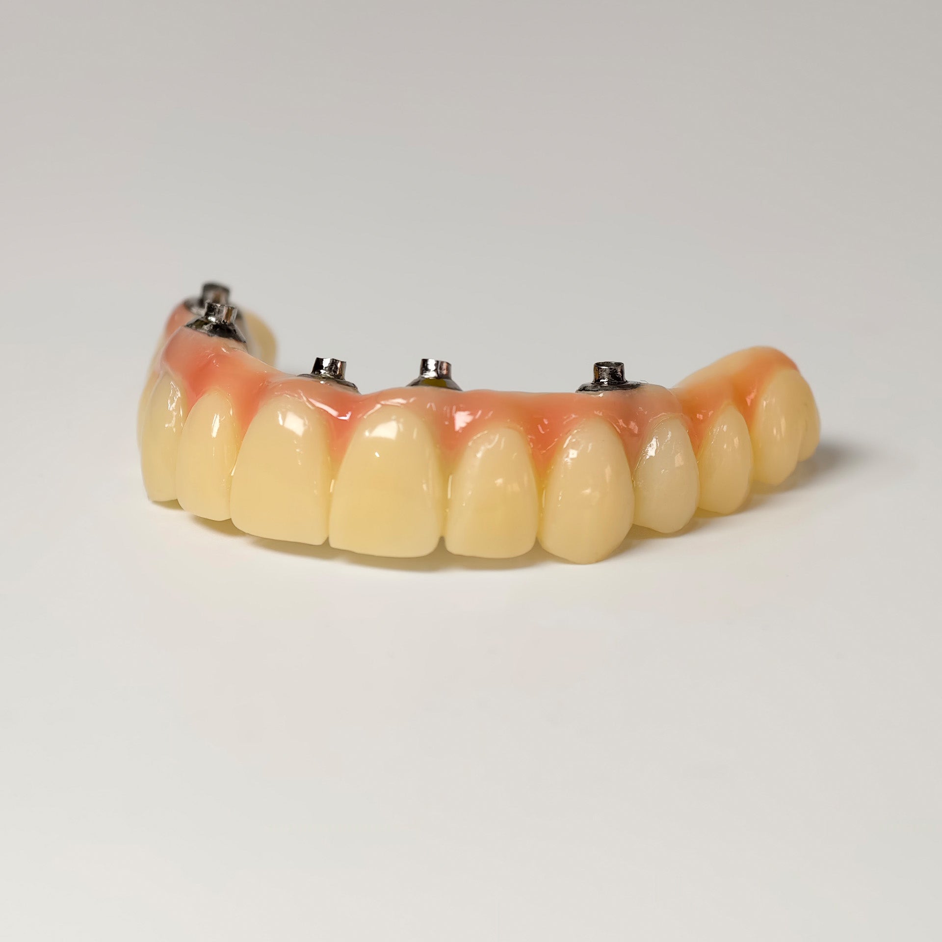 PMMA Bridge With Screw Retained