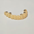 PMMA Bridge With Screw Retained