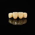 Pmma Bridge With Cement Retained