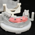 Pmma Bridge With Cement Retained