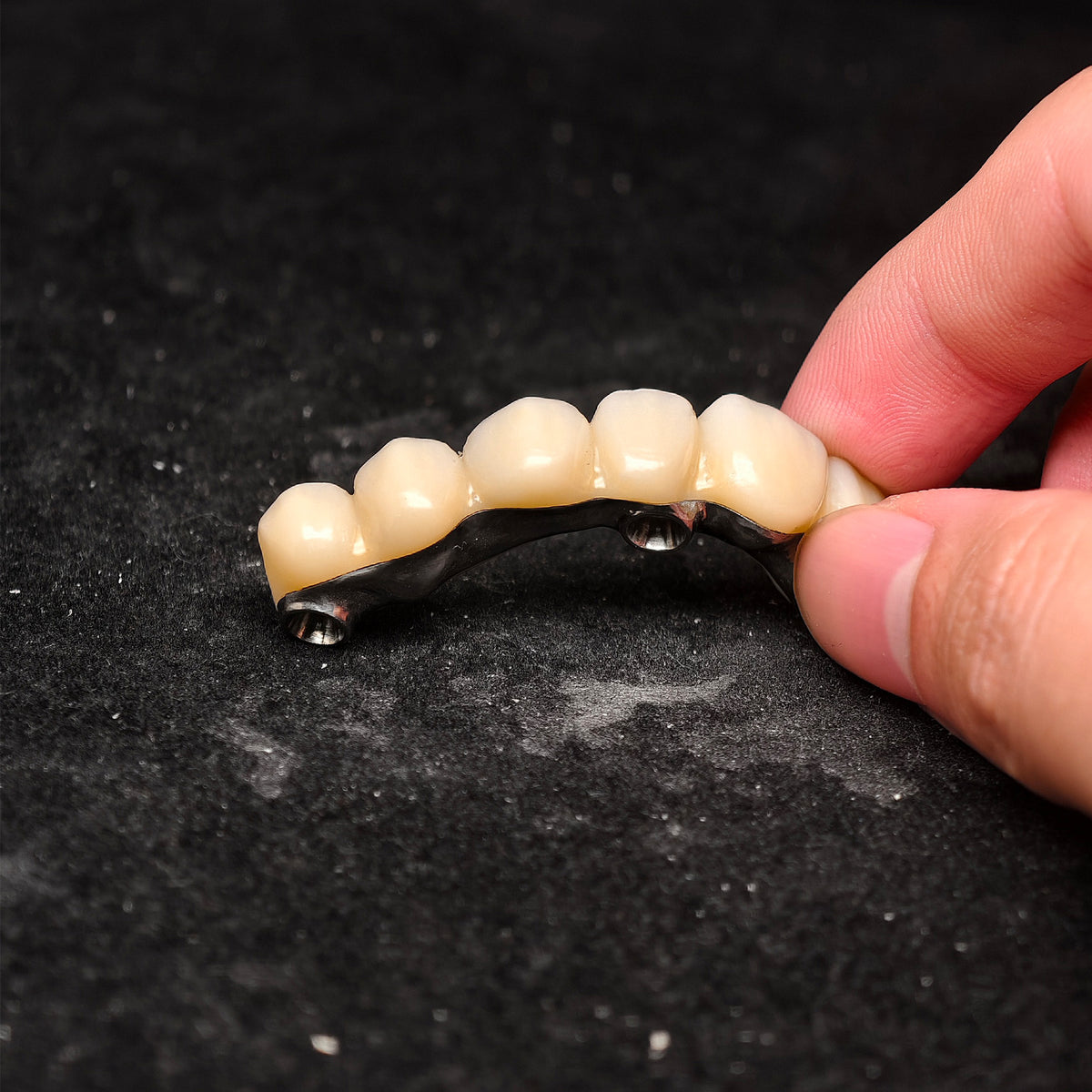 Ti-Bar Pure Titanium Metal Frame With Zirconia Bridge Implant