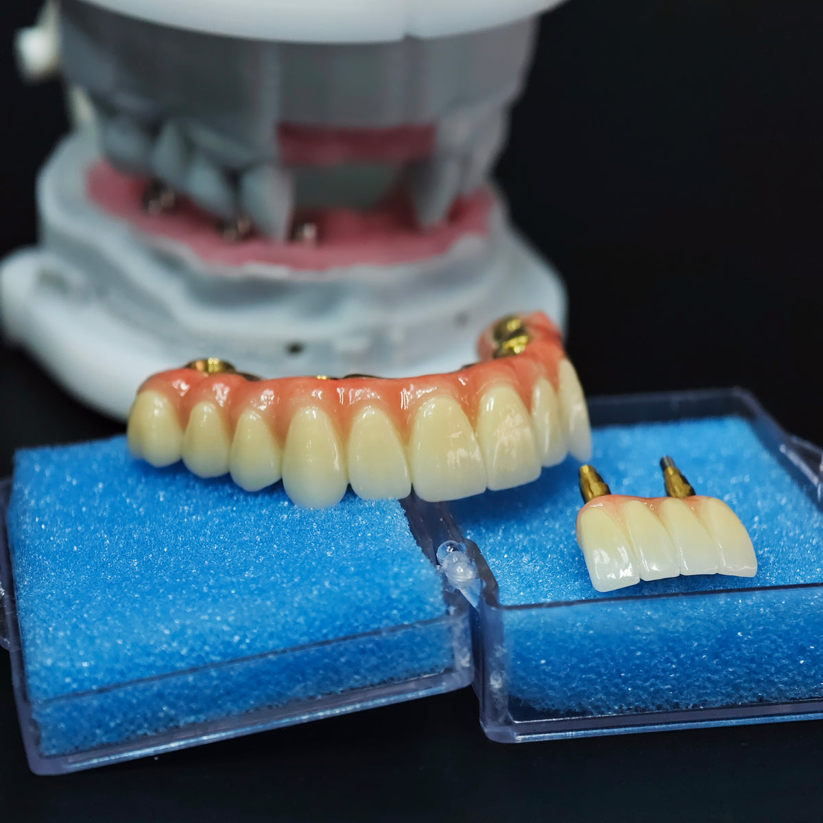 Ti-Bar Titanium Nitride Metal Frame With Zirconia Bridge For Full Arch Restoration