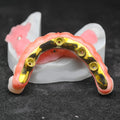 Ti-Bar Titanium Nitride Metal Frame With Zirconia Bridge For Full Arch Restoration