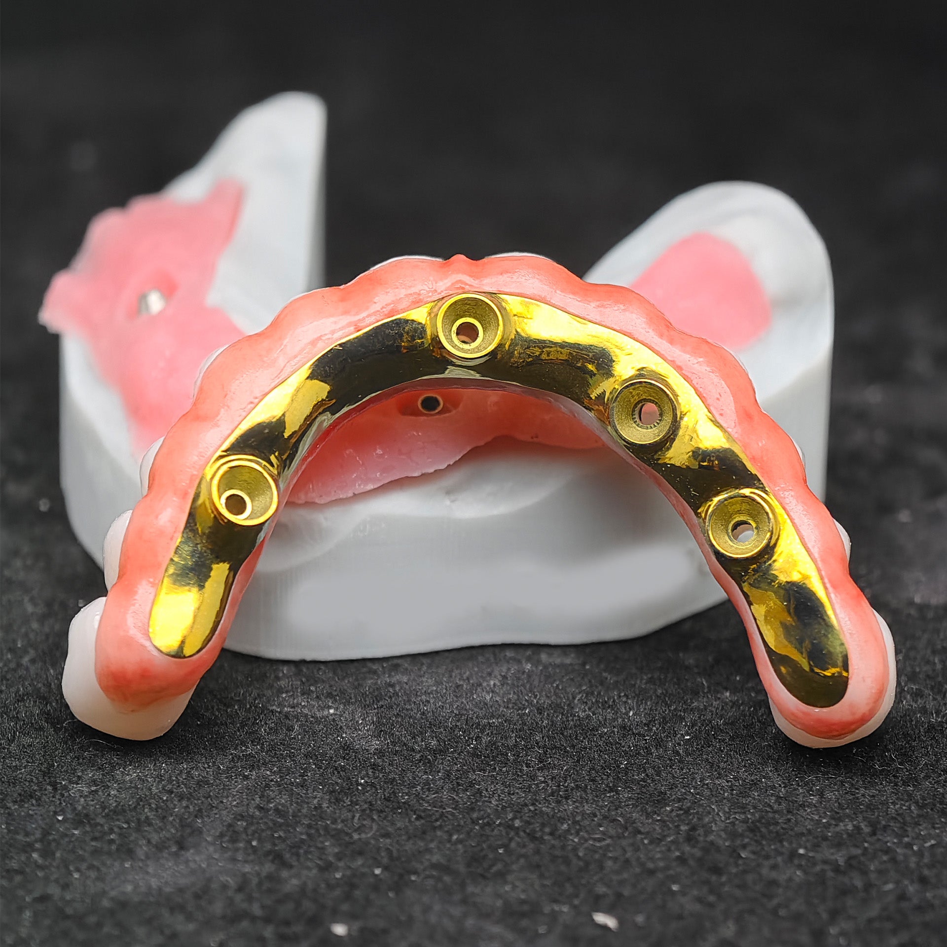 Ti-Bar Titanium Nitride Metal Frame With Zirconia Bridge For Full Arch Restoration