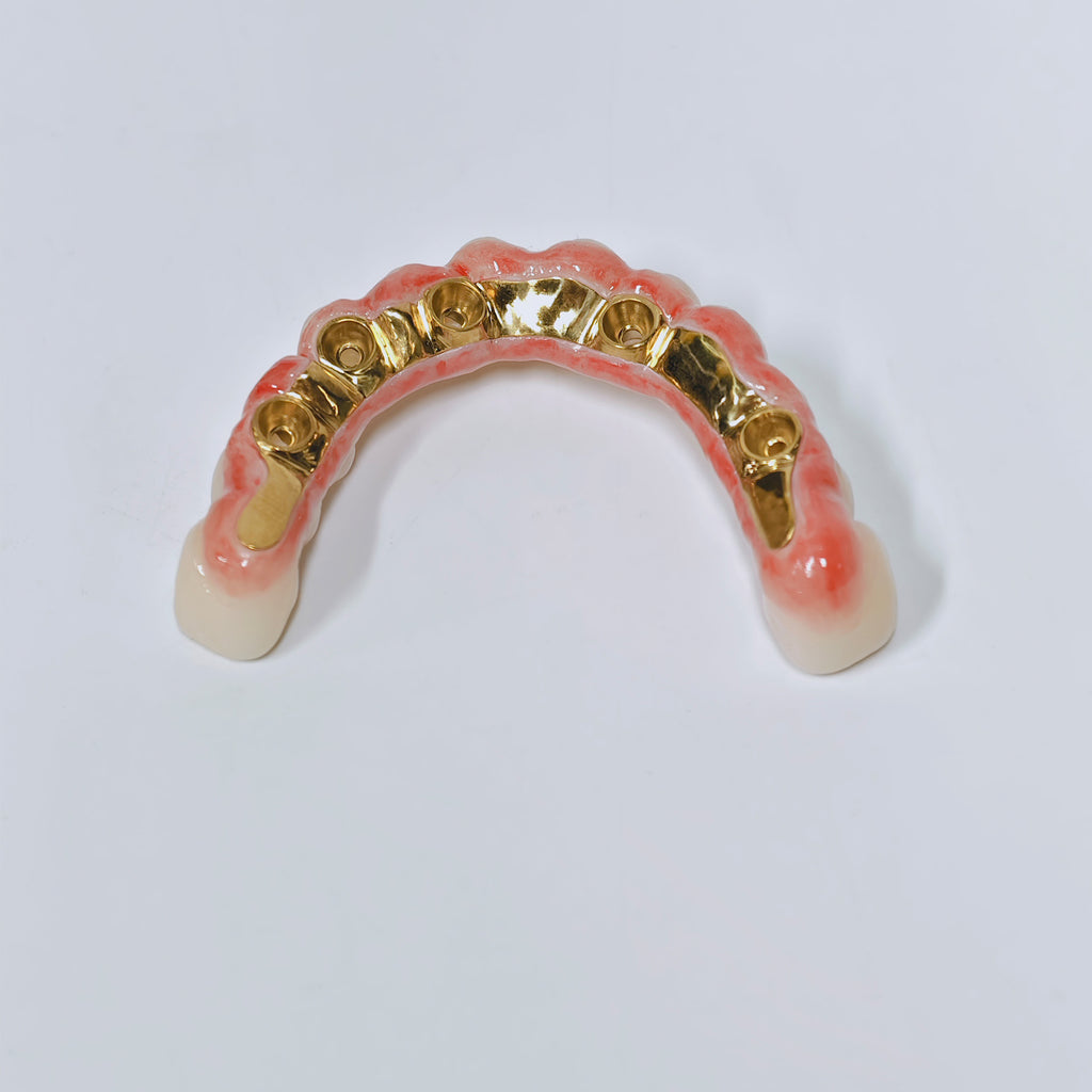 Ti-Bar Titanium Nitride Metal Frame With Zirconia Bridge For Full Arch Restoration