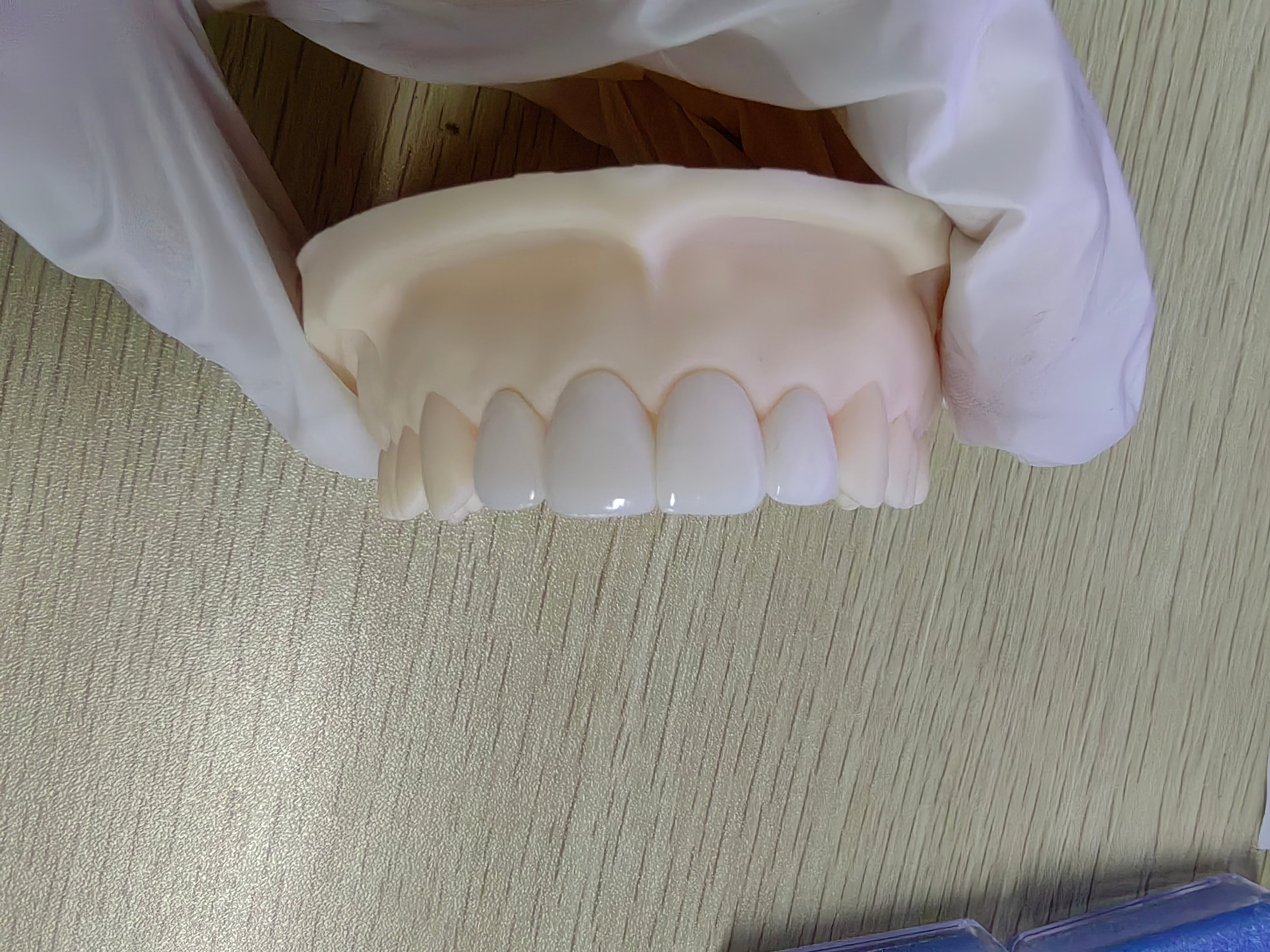 Ultra-Thin Emax Veneer. High Transparency/Translucent, Natural Shade