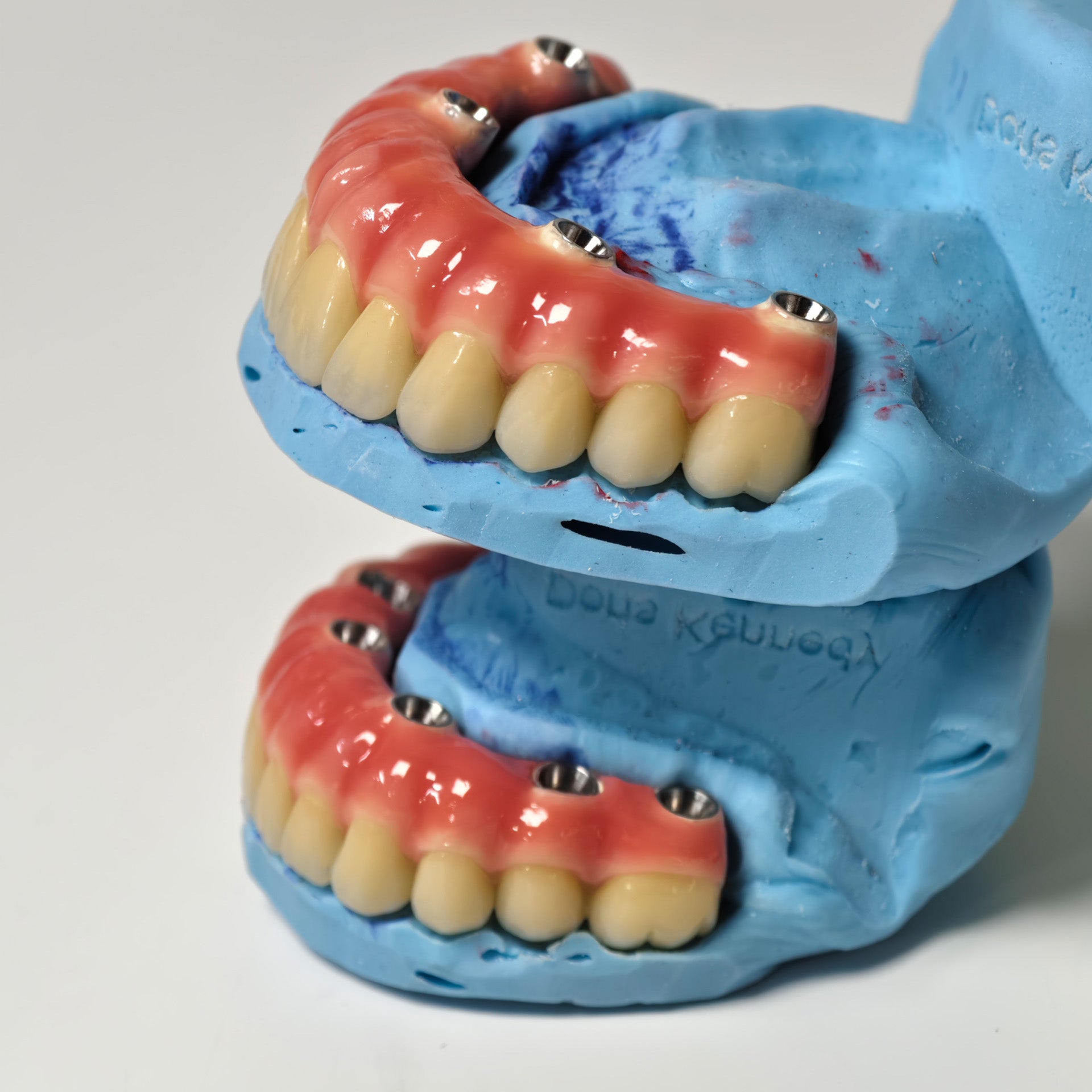 Zirconia-Enamel Hybrid Malo Bridge