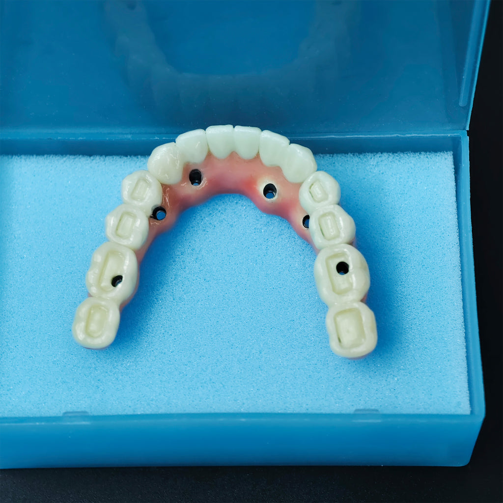 Zirconia-Enamel Hybrid Malo Bridge