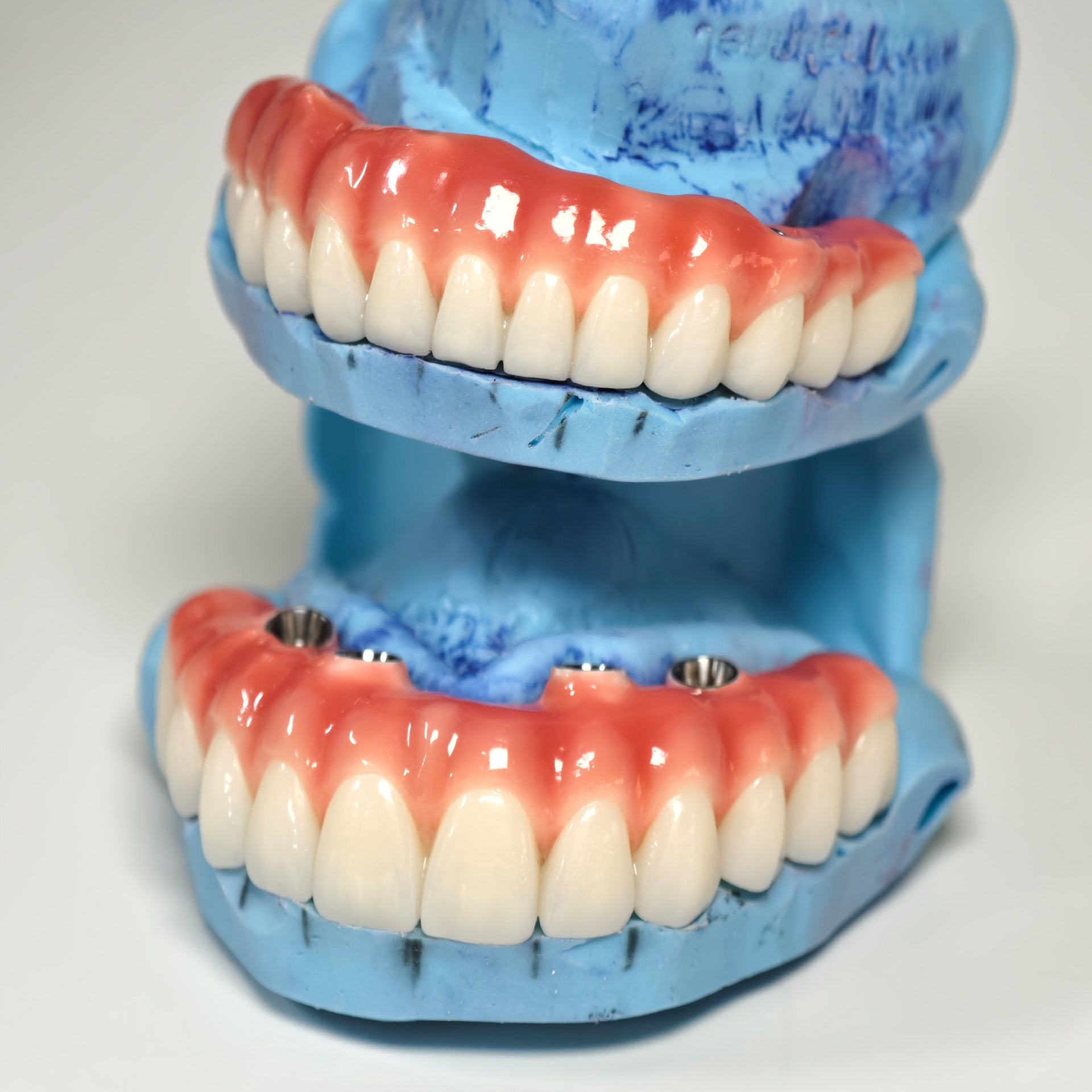 Zirconia-Enamel Hybrid Malo Bridge