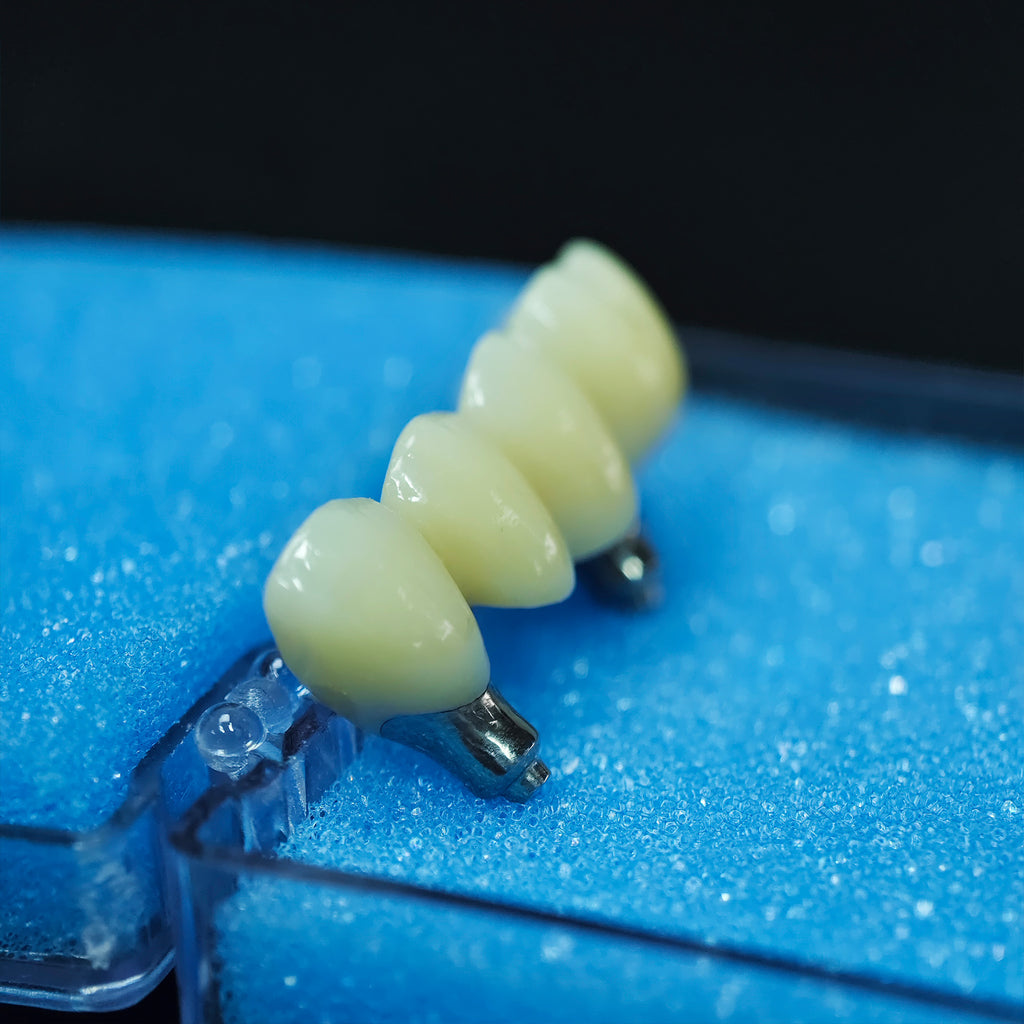 Zirconia Bridge With Screw Retained
