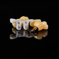Zirconia Crowns With Gold-Plated Abutment And Implant Seating Guide