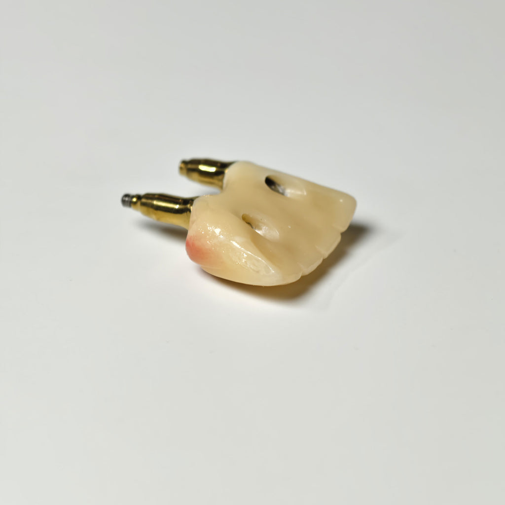 Zirconia Crown With Gold-Plated Abutment