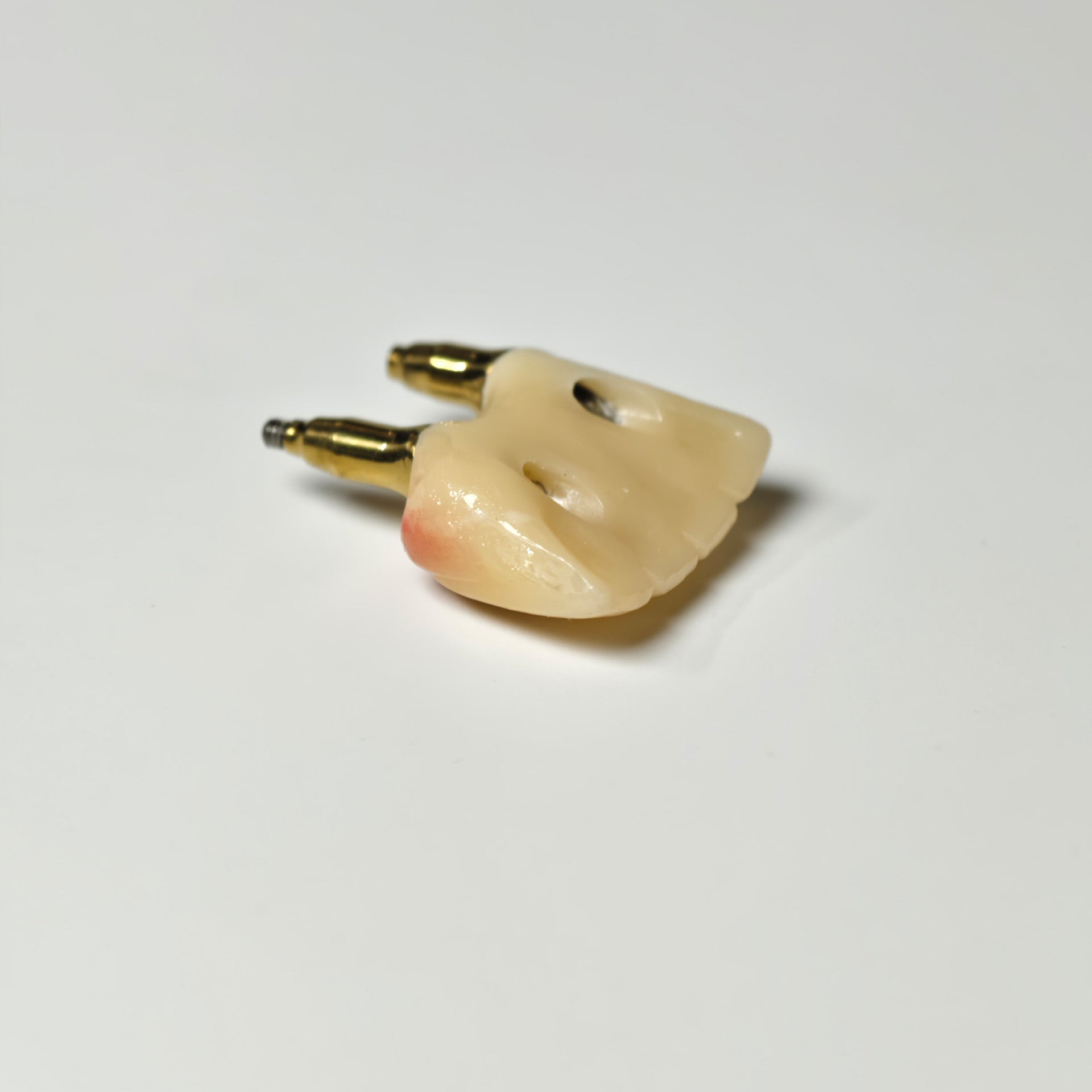 Zirconia Crown With Gold-Plated Abutment