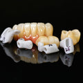 Zirconia Implant Bridge Screwmentable Dental Crown