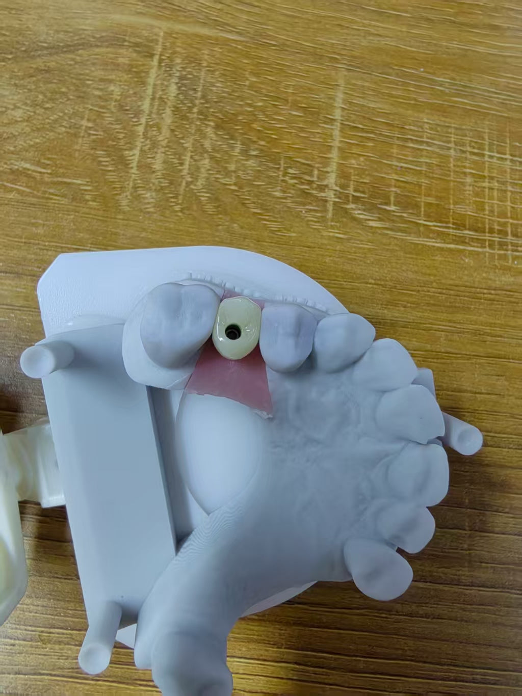 Zirconia Implant Crown Screwmentable Dental Crown