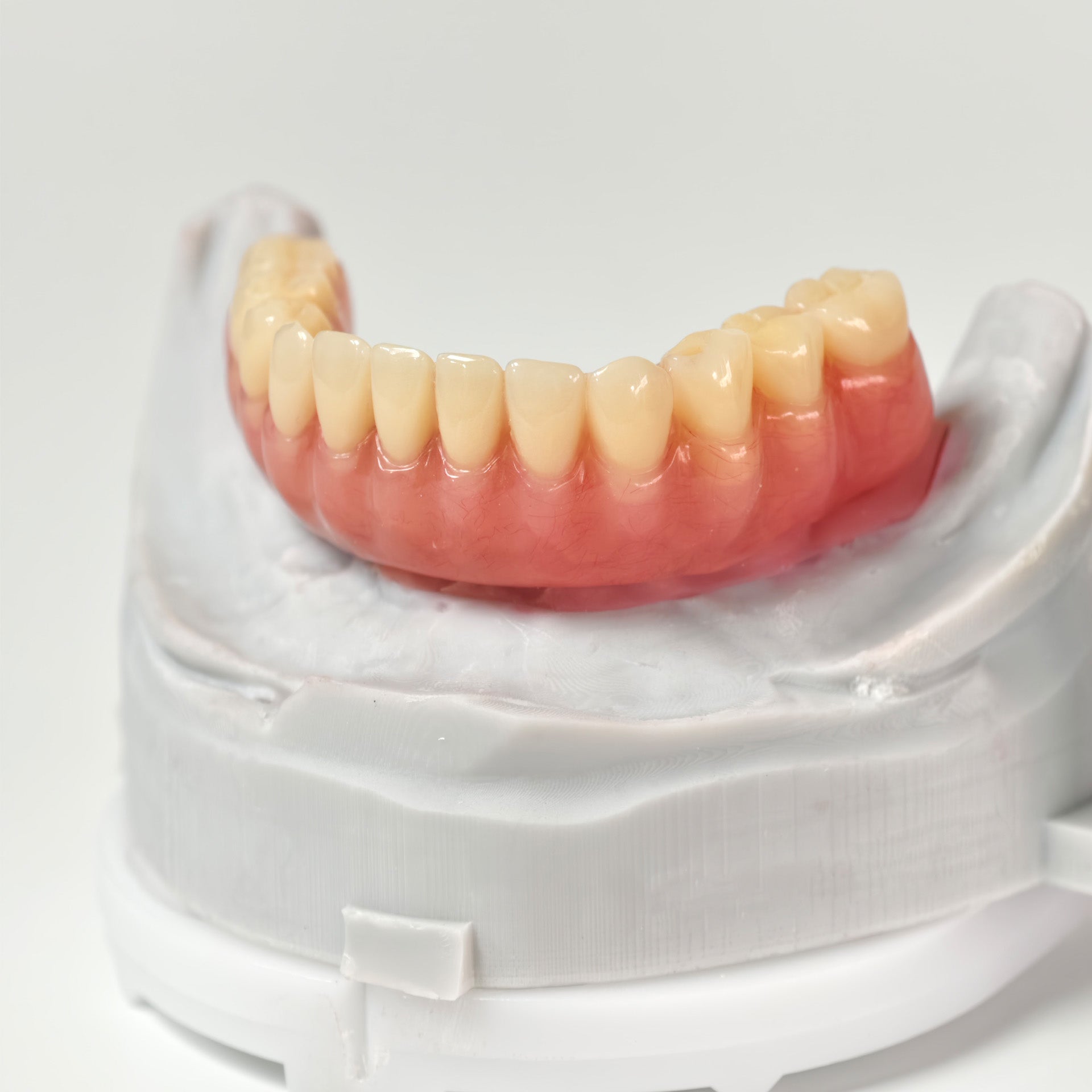 Acrylic Denture With Ti-Bar And Screw Retained