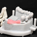 Custom Zirconia Implant Crowns