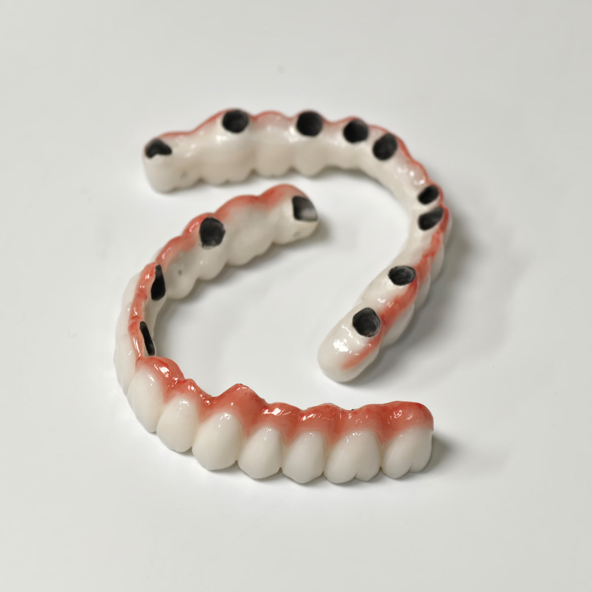 Full-Arch PFM Bridge With Screw Retained