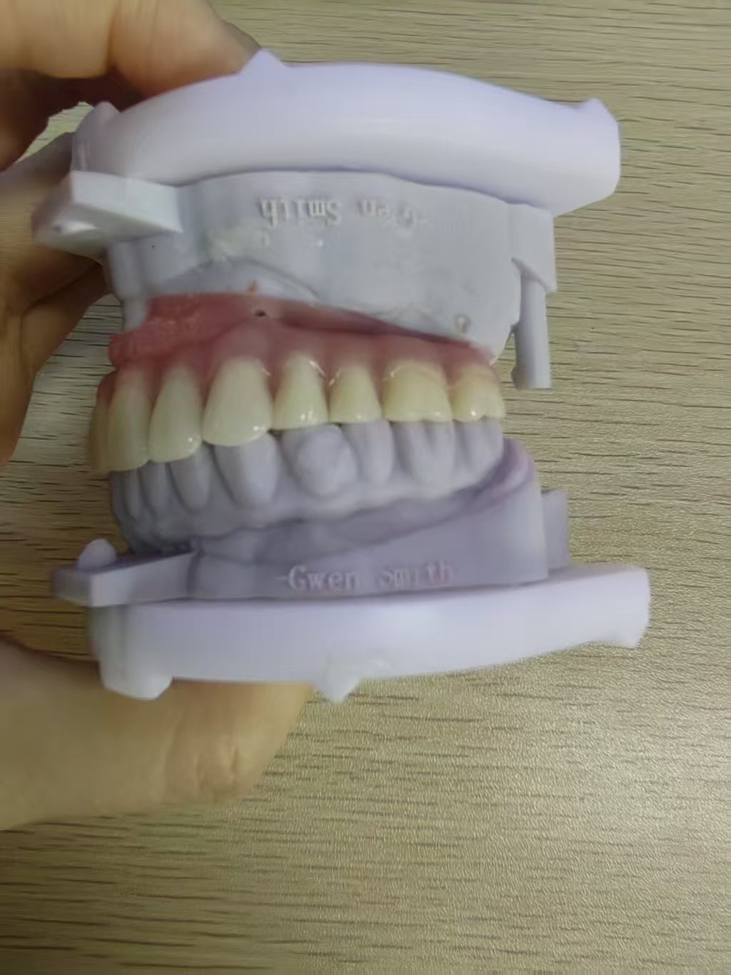 An Acrylic Denture With A Titanium Bar (Ti-Bar) Cost-Effective Full Arch Restoration Screw Retained