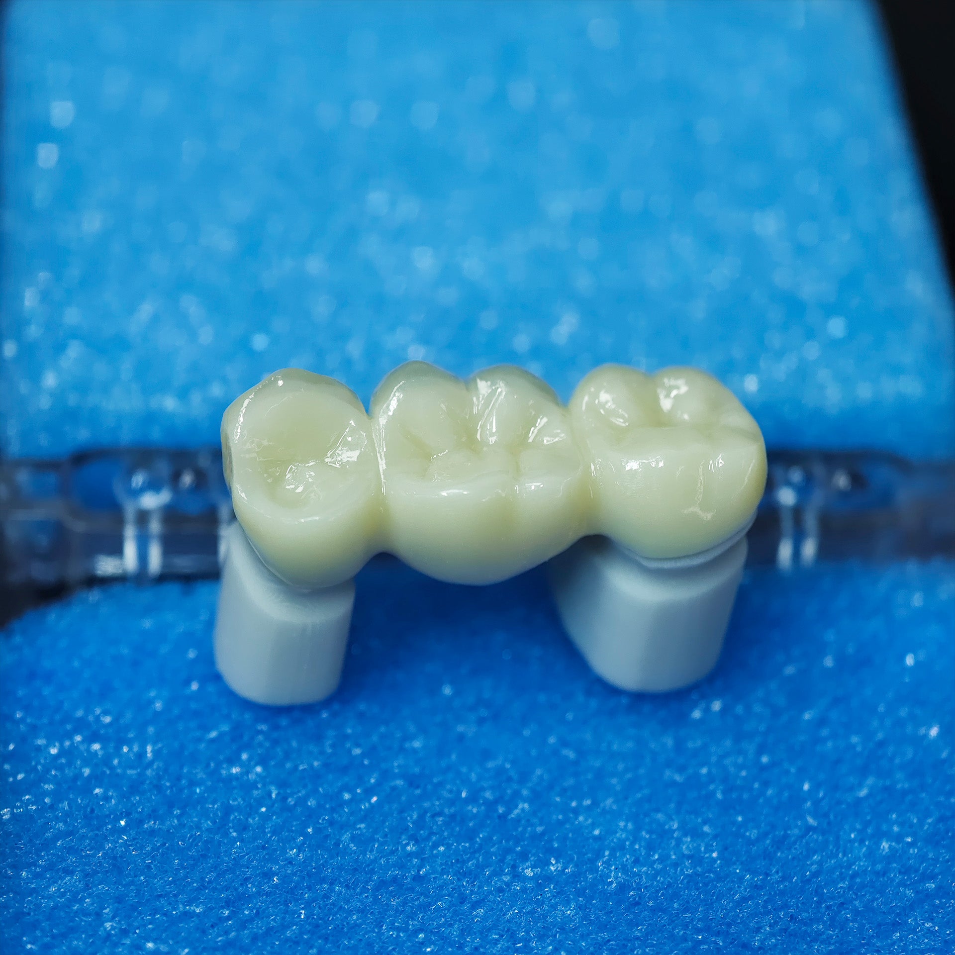 Beautiful Zirconia Bridge
