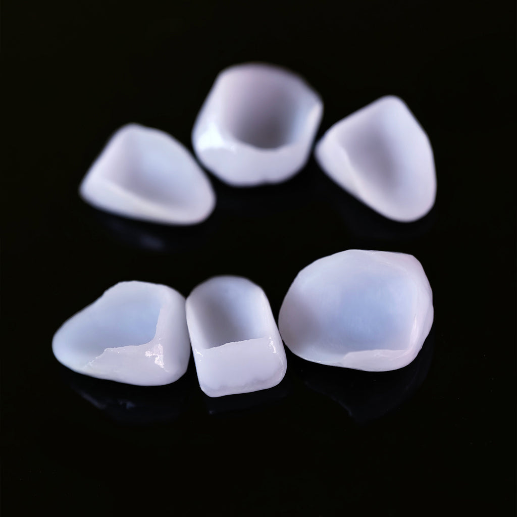 Ceramic Veneers And Crown With Cement Retained
