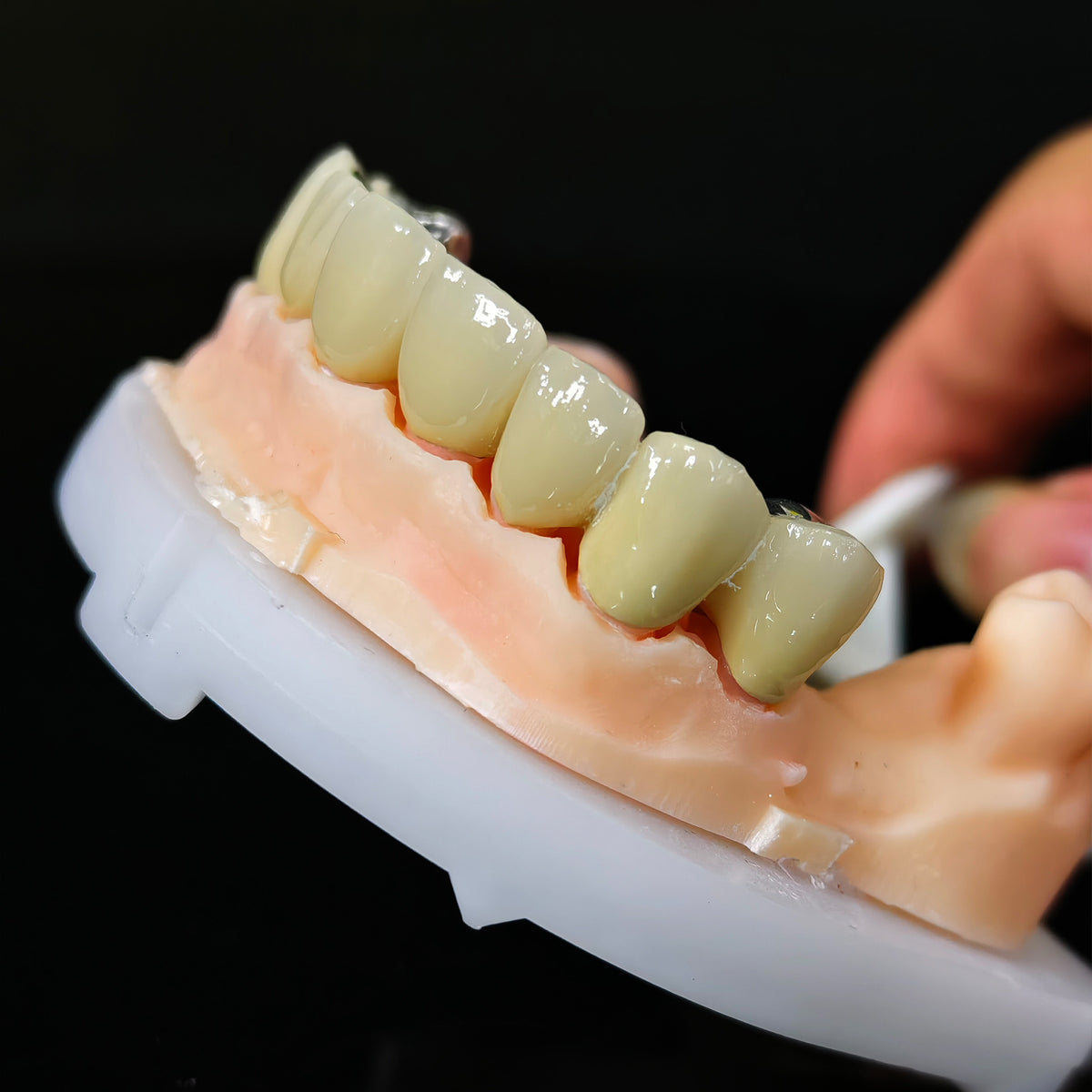 Co - Cr PFM Dental Bridge
