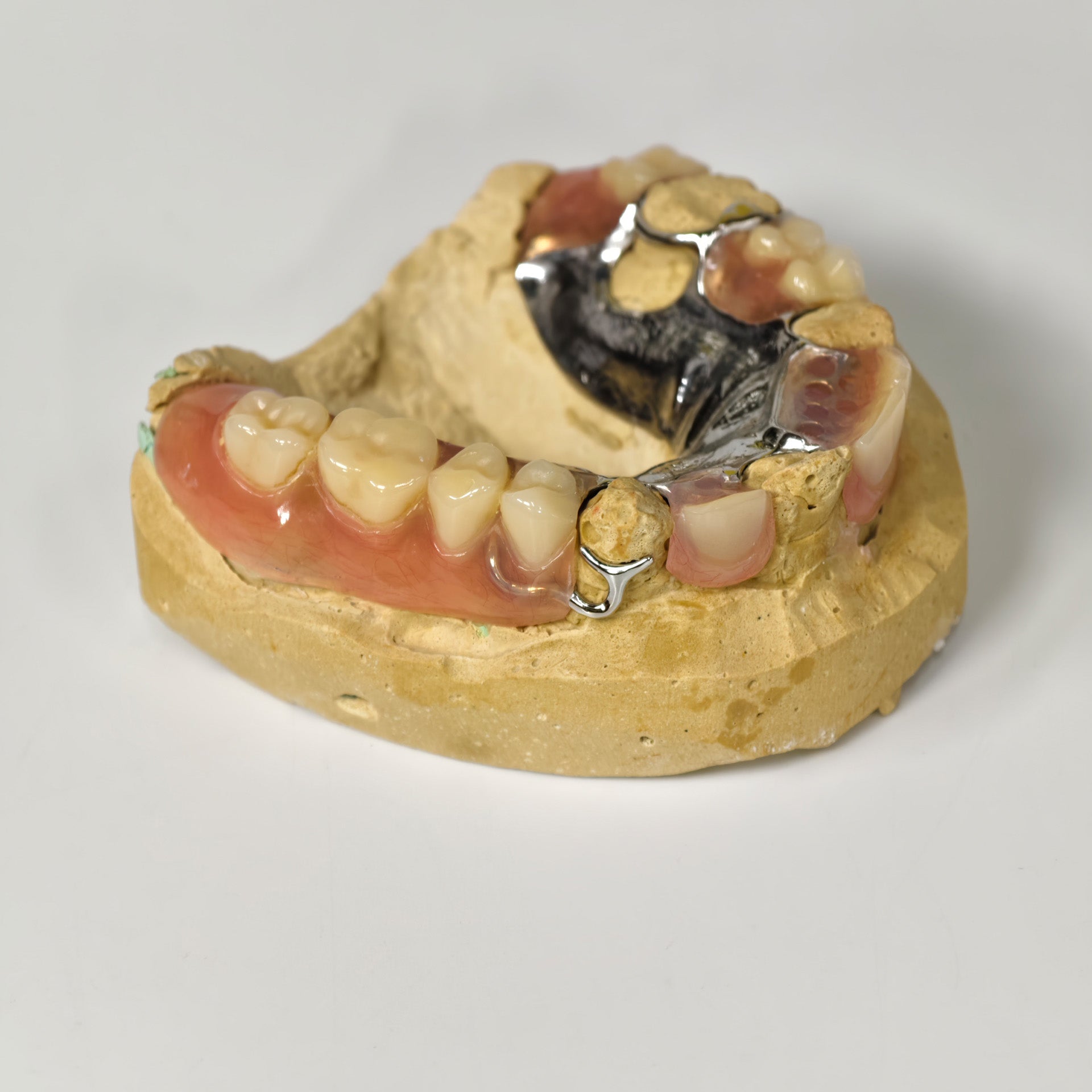 Cobalt Chrome Framework Denture Metal Framework With Acrylic Denture