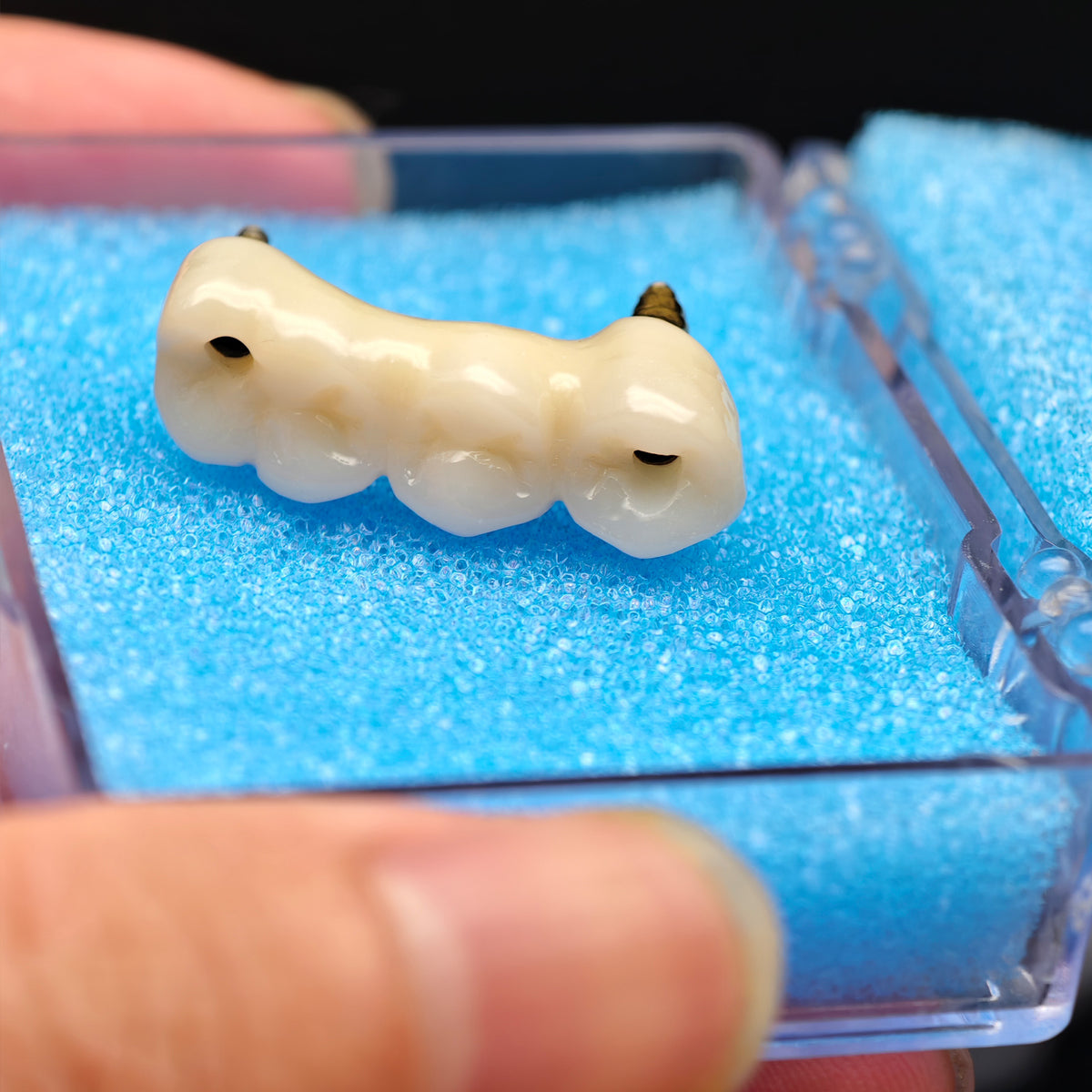 Custom Zirconia Implant Bridge