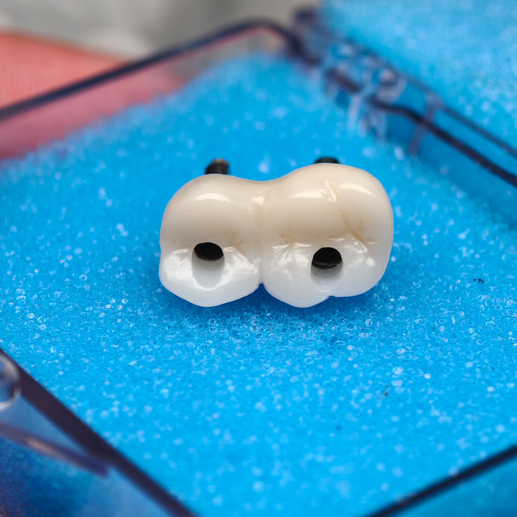 Custom Zirconia Implant Bridge