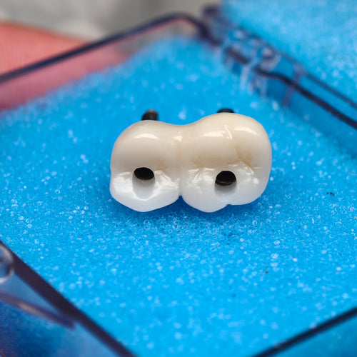Custom Zirconia Implant Bridge