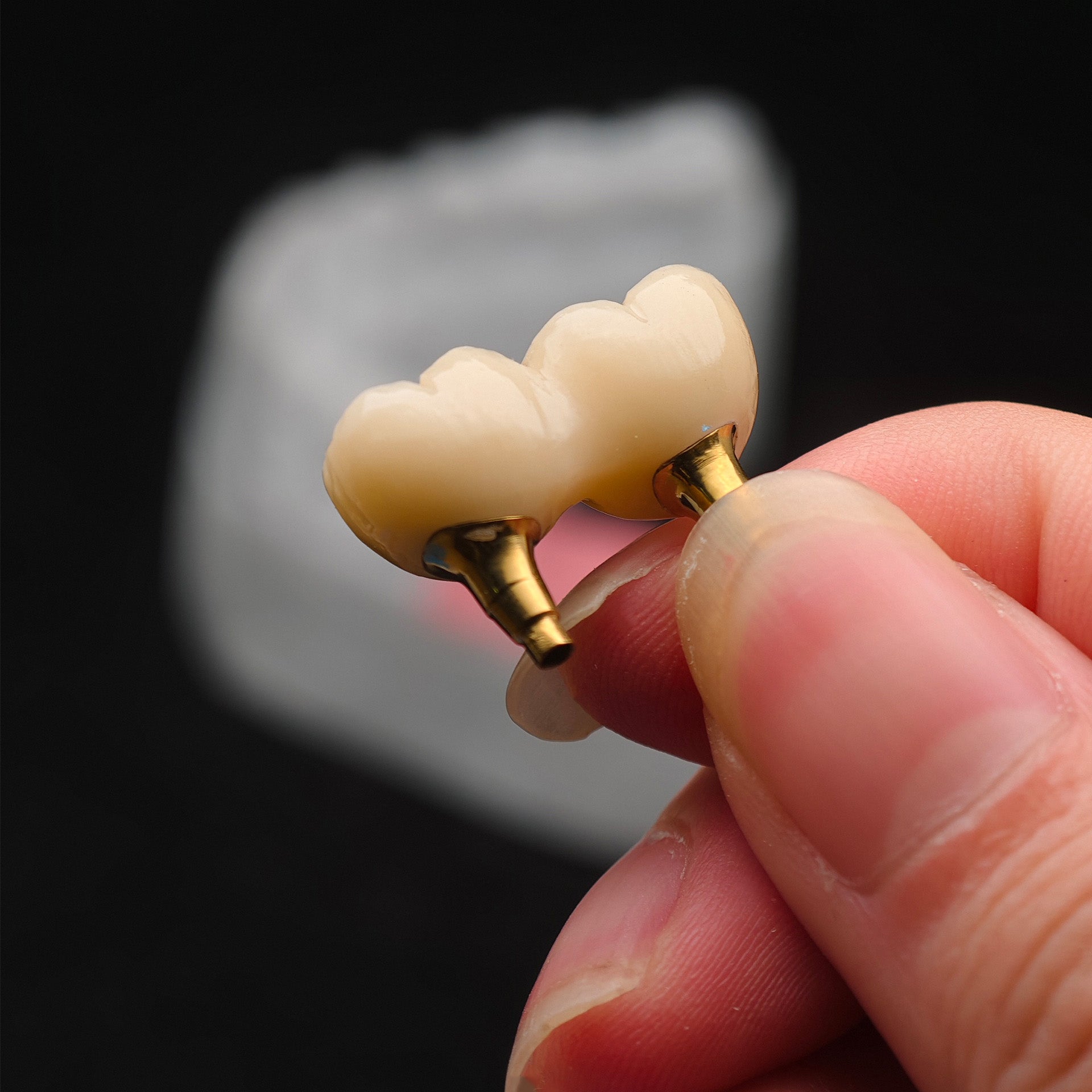 Custom Zirconia Implant Bridge