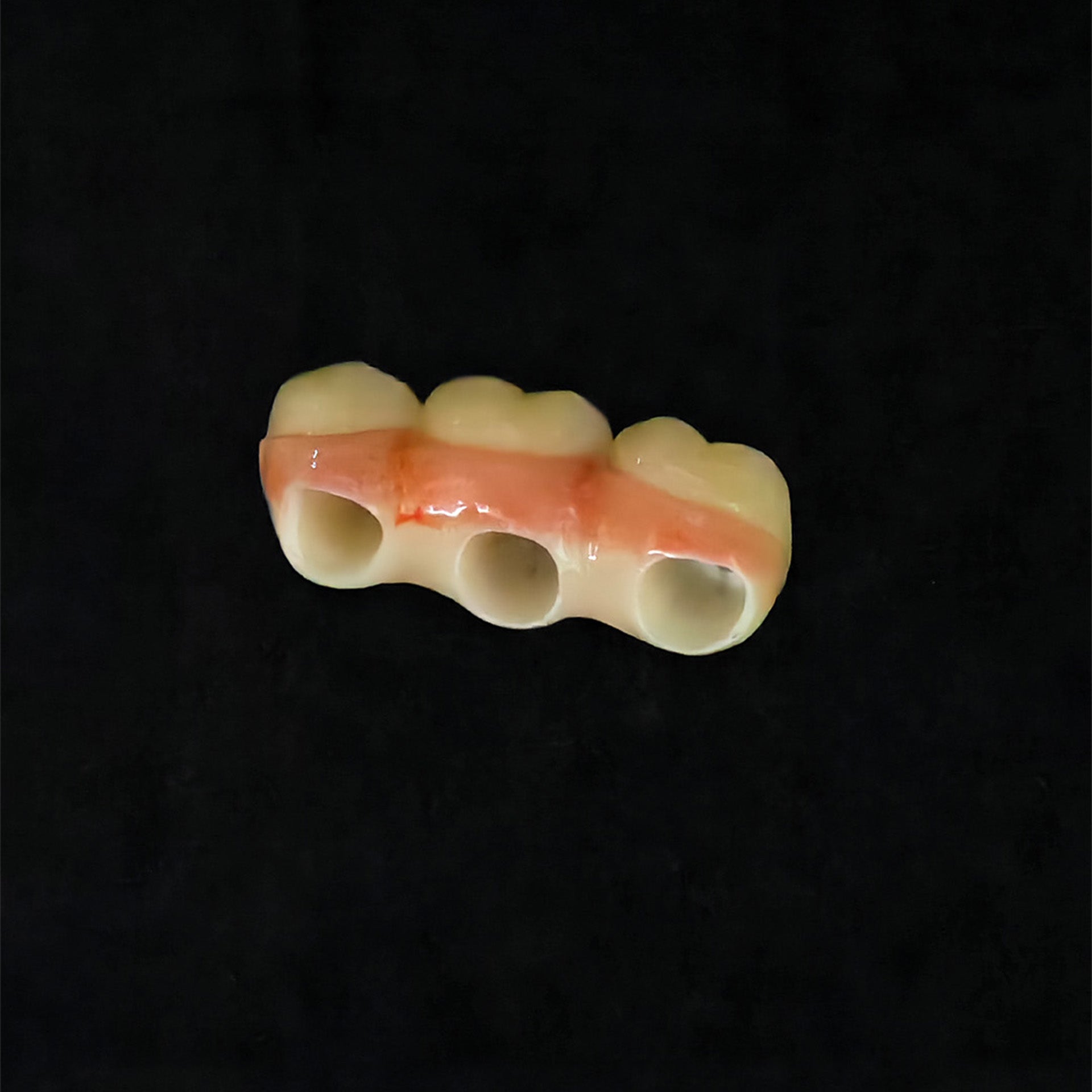 Custom Zirconia Implant Bridge