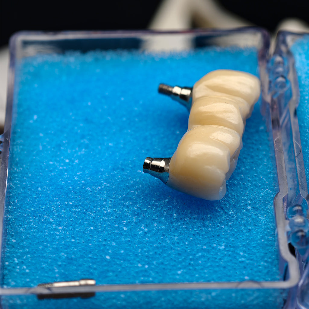 Custom Zirconia Implant Bridge