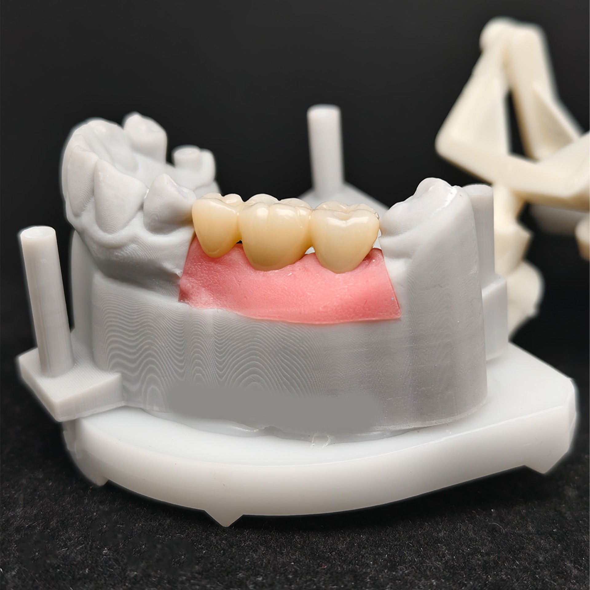 Custom Zirconia Implant Bridge