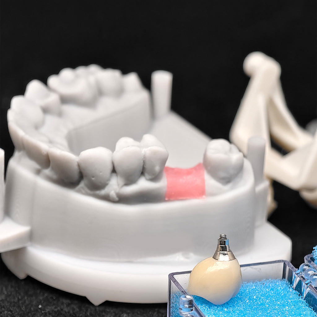 Custom Zirconia Implant Crown