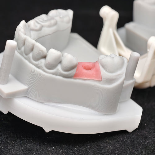 Custom Zirconia Implant Crowns