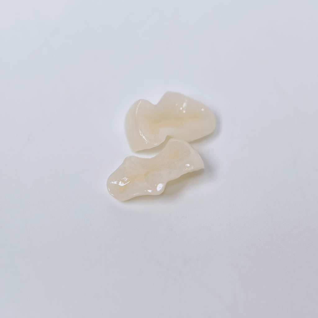 E.Max Inlay/Onlay