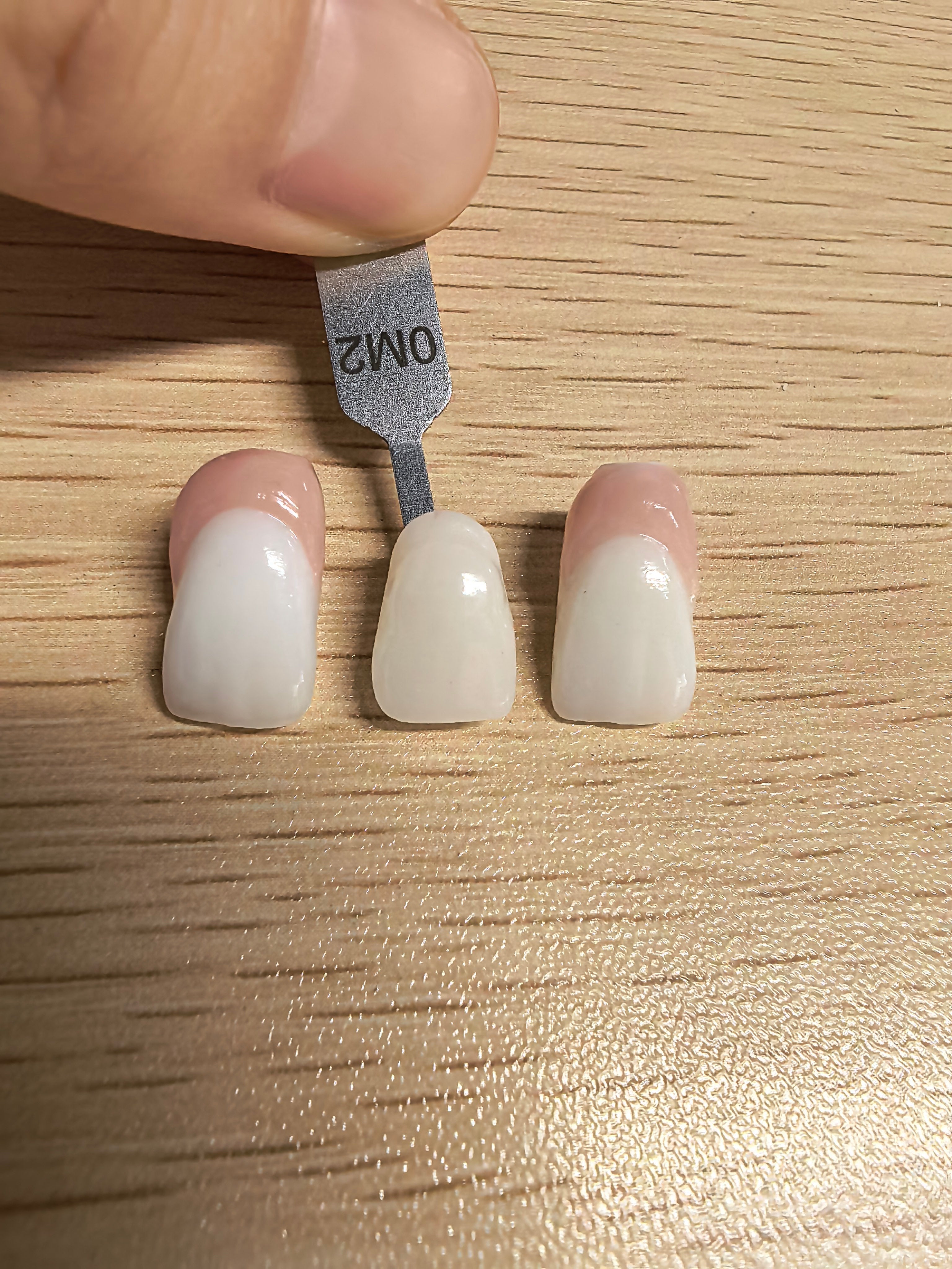 E.Max Implant Crown With Custom Abutment