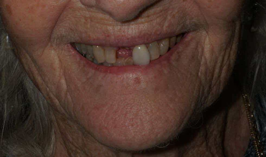 Emax With Porcelain Powder High Aesthetics
