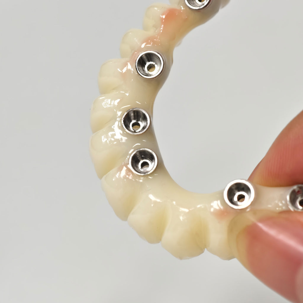 Full-Arch PMMA Bridge With Ti-Base Screw Retained
