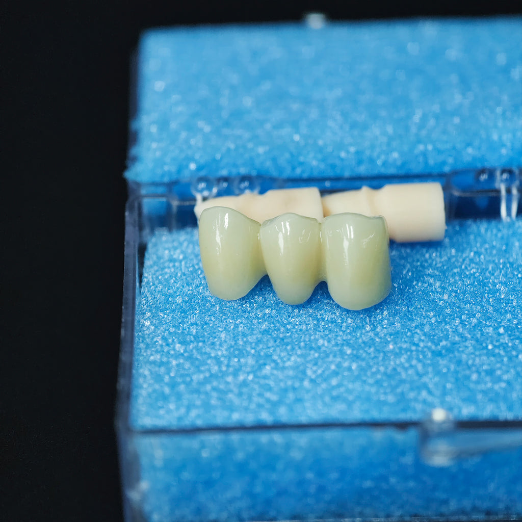 High - Strength Zirconia Bridge