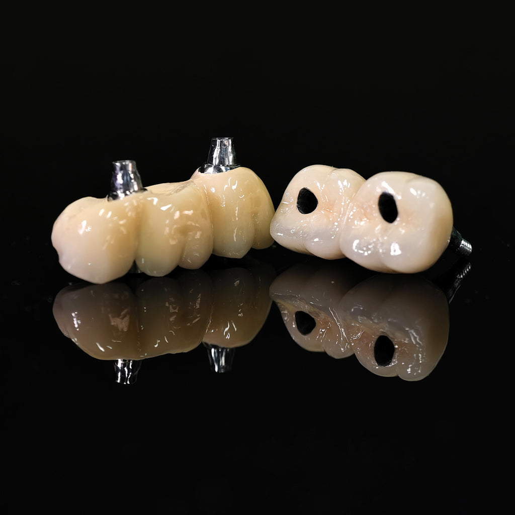 Implant-supported Co - Cr PFM Dental Bridge