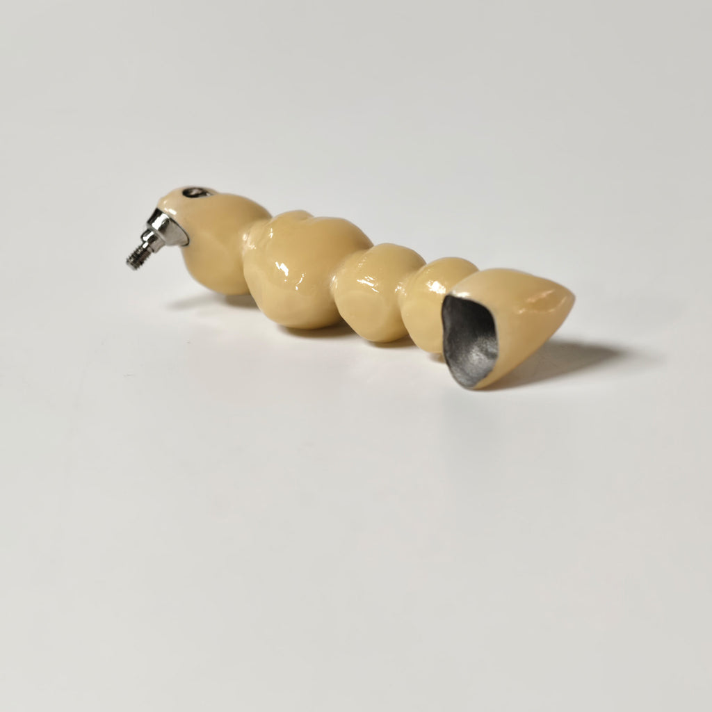 Implant-Supported PFM Single Bridge