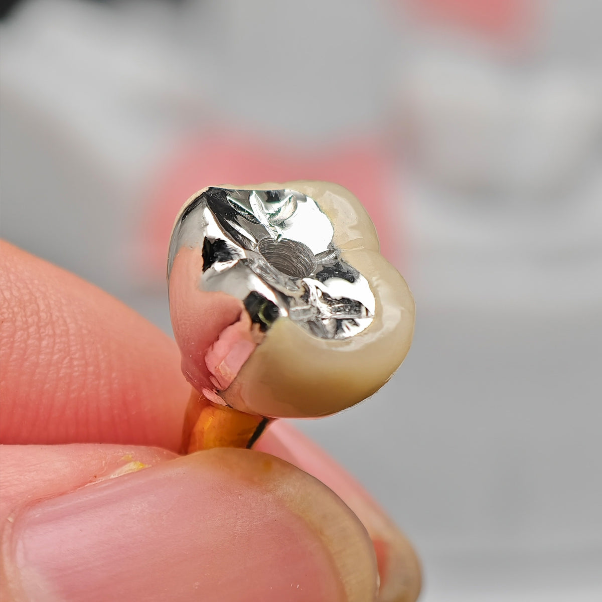 Implant-Supported PFM Single Crown With Metal
