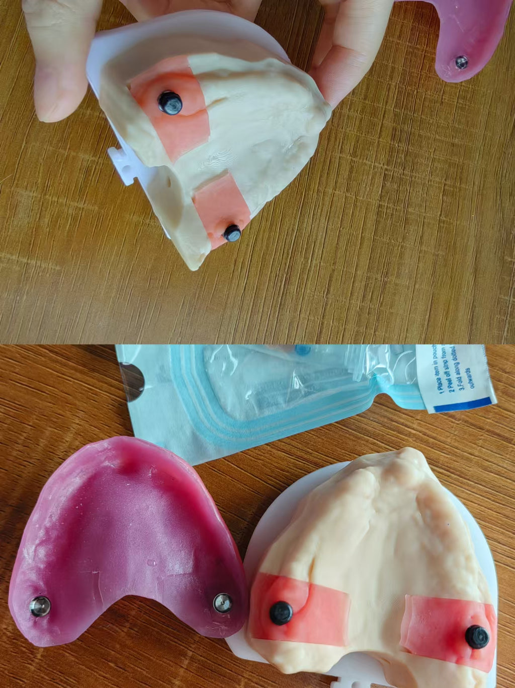 Locator Overdenture Implant Acrylic Denture Restoration