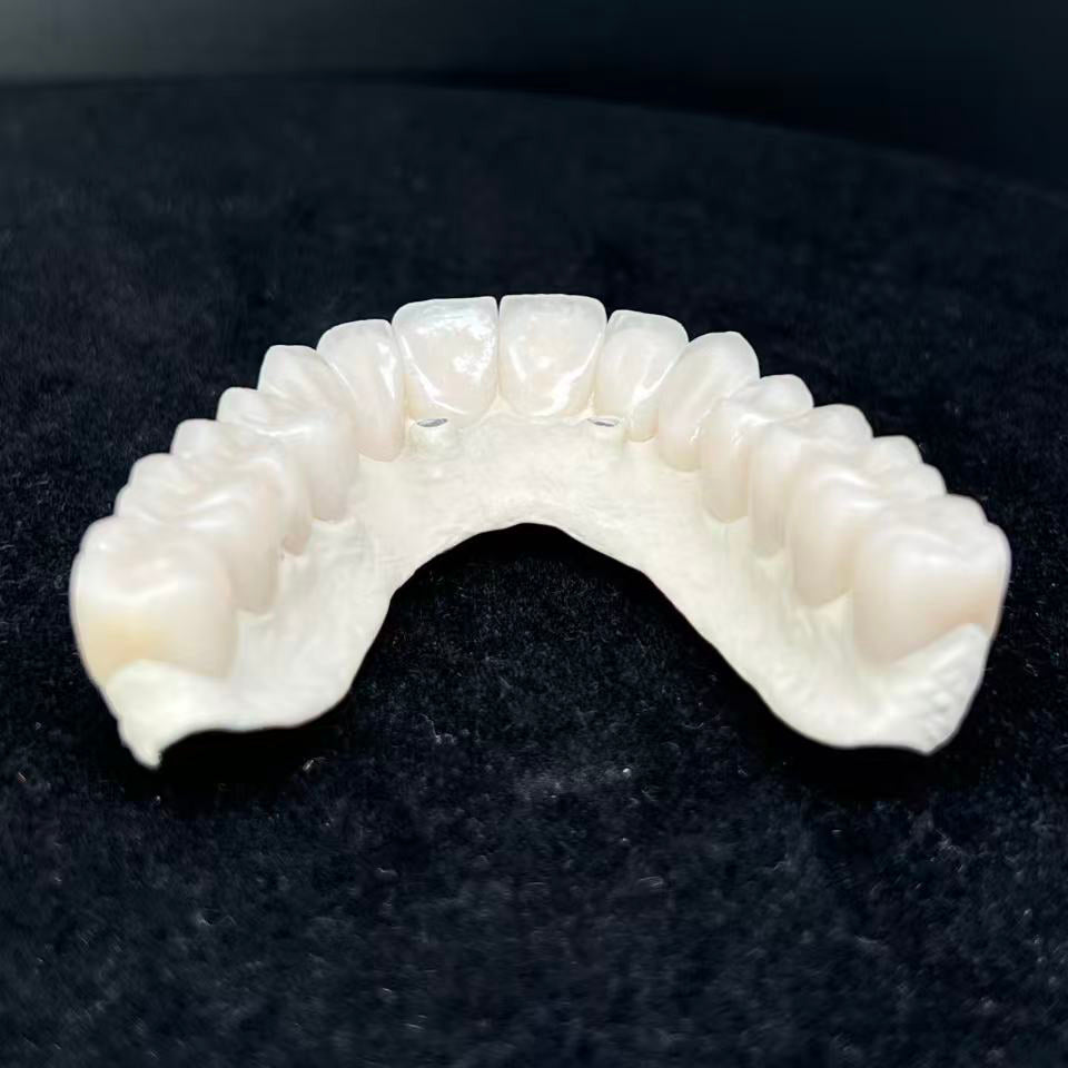 Malo Bridge Implant Restorations