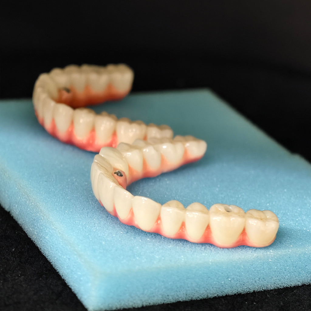 Malo Bridge Implant Restorations